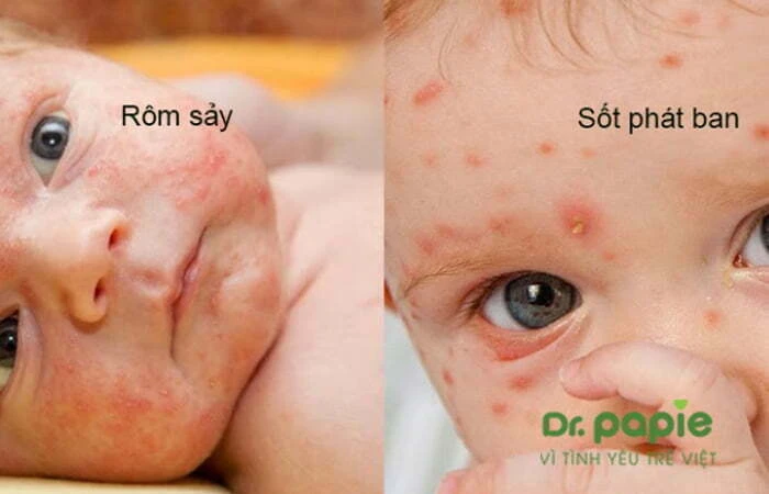 Chuỗi 17+ hình ảnh sốt phát ban ở trẻ giúp mẹ chuẩn đoán nhanh bệnh Hình ảnh phân biệt với phát ban do rôm sảy với phát ban do sốt phát ban