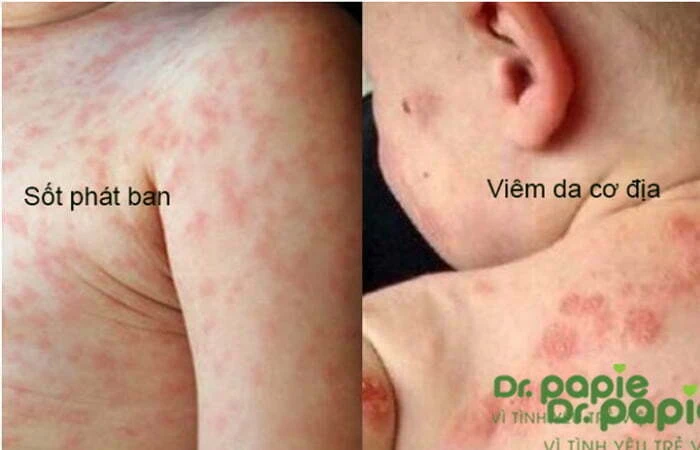 Chuỗi 17+ hình ảnh sốt phát ban ở trẻ giúp mẹ chuẩn đoán nhanh bệnh Hình ảnh phân biệt sốt phát ban với phát ban do viêm da cơ địa