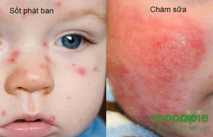 Chuỗi 17+ hình ảnh sốt phát ban ở trẻ giúp mẹ chuẩn đoán nhanh bệnh Hình ảnh phân biệt sốt phát ban với phát ban do chàm sữa