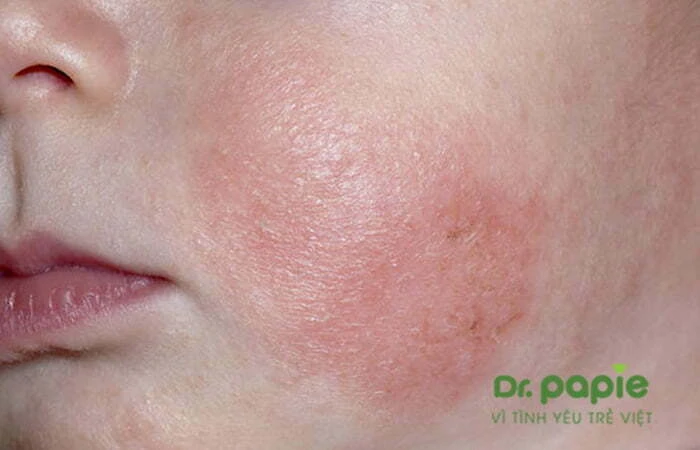 Chuỗi hình ảnh viêm da cơ địa ở trẻ sơ sinh theo từng giai đoạn, mức độ của bệnh Hình ảnh Trẻ bị viêm da cơ địa