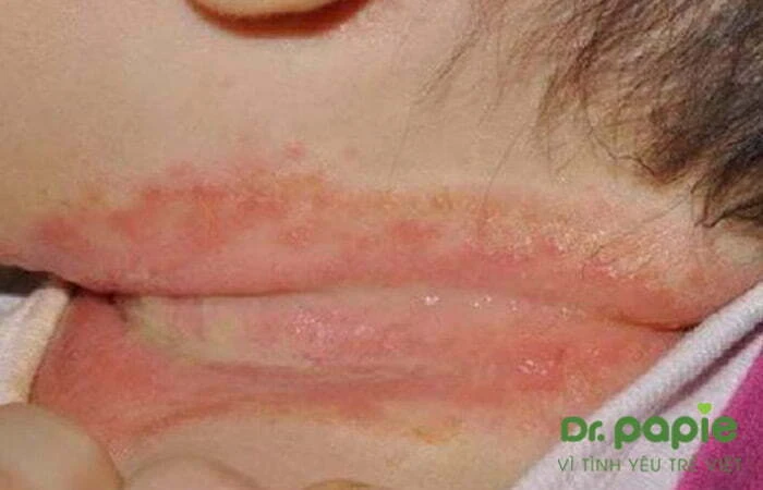 Chuỗi hình ảnh viêm da cơ địa ở trẻ sơ sinh theo từng giai đoạn, mức độ của bệnh Hình ảnh trẻ bị viêm da cơ địa ở cổ