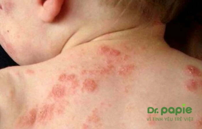 Chuỗi hình ảnh viêm da cơ địa ở trẻ sơ sinh theo từng giai đoạn, mức độ của bệnh Hình ảnh Viêm da cơ địa lan từ cổ xuống lưng