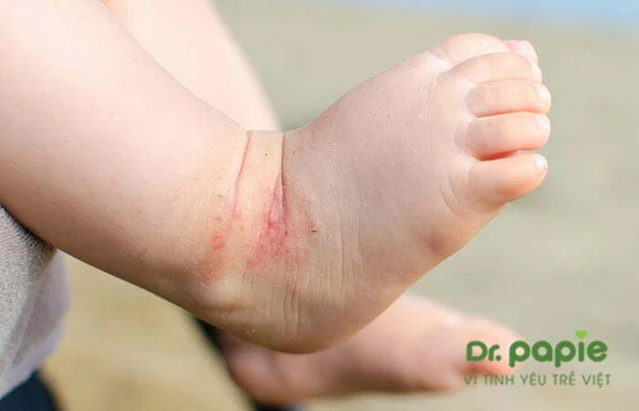 Chuỗi hình ảnh viêm da cơ địa ở trẻ sơ sinh theo từng giai đoạn, mức độ của bệnh Hình ảnh trẻ bị viêm da cơ địa ở chân