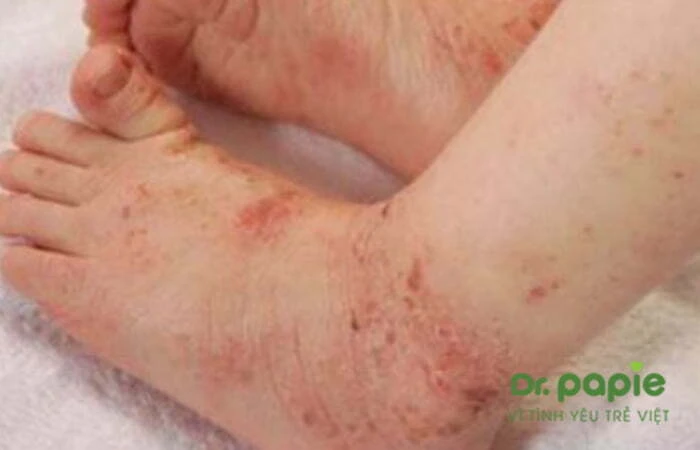 Chuỗi hình ảnh viêm da cơ địa ở trẻ sơ sinh theo từng giai đoạn, mức độ của bệnh Hình ảnh trẻ bị viêm da cơ địa ở chân