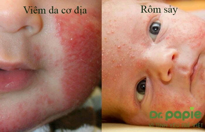 Chuỗi hình ảnh viêm da cơ địa ở trẻ sơ sinh theo từng giai đoạn, mức độ của bệnh Phân biệt với viêm da do rôm sảy với viêm da cơ địa