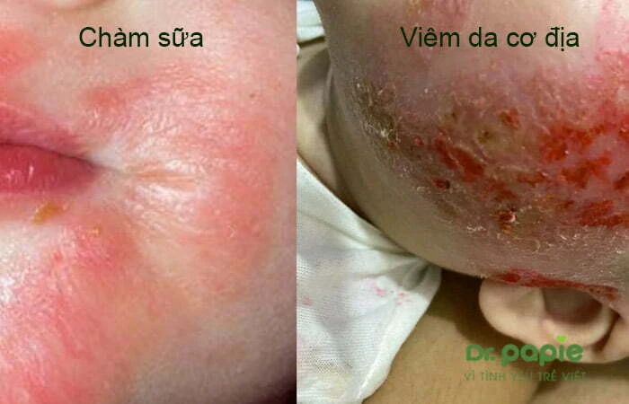 Chuỗi hình ảnh viêm da cơ địa ở trẻ sơ sinh theo từng giai đoạn, mức độ của bệnh Phân biệt với viêm da do chàm sữa với viêm da cơ địa