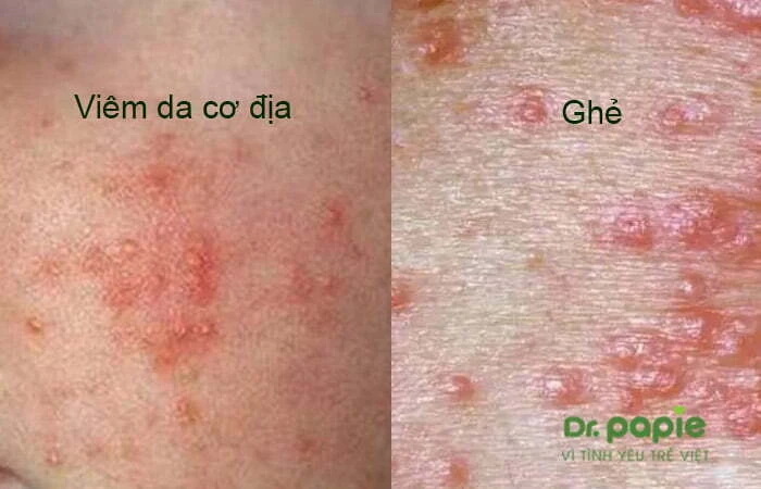 Chuỗi hình ảnh viêm da cơ địa ở trẻ sơ sinh theo từng giai đoạn, mức độ của bệnh Phân biệt với viêm da do ghẻ lở với viêm da cơ địa