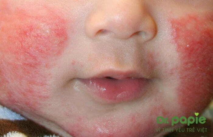 Chuỗi hình ảnh viêm da cơ địa ở trẻ sơ sinh theo từng giai đoạn, mức độ của bệnh Hình ảnh bé bị Viêm da cơ địa mạn tính