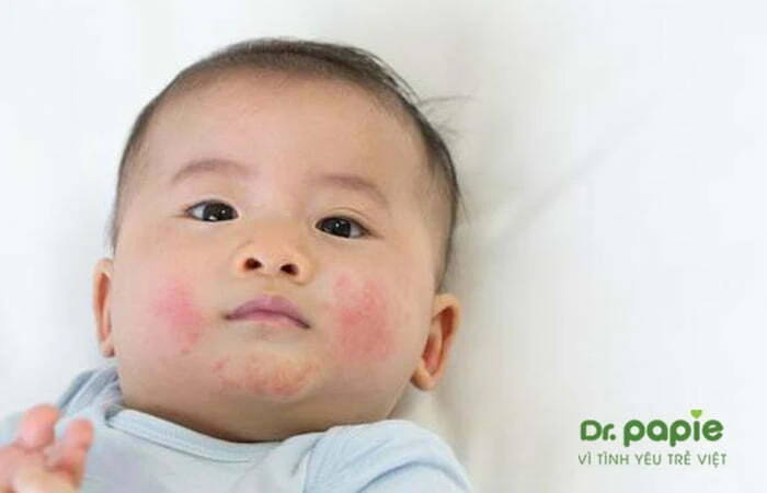 Chuỗi hình ảnh viêm da cơ địa ở trẻ sơ sinh theo từng giai đoạn, mức độ của bệnh Hình ảnh viêm da cơ địa ở mặt của trẻ