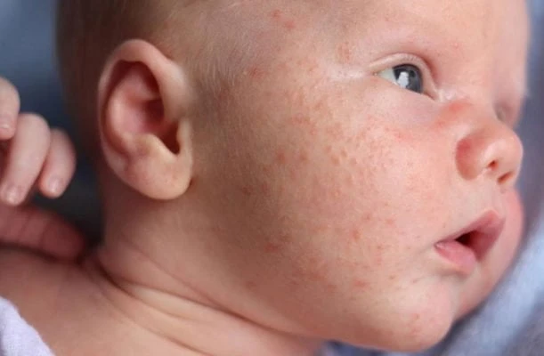 Chuyên gia khuyến cáo chàm sữa ở trẻ có nguy hiểm không? chuyen gia khuyen cao cham sua o tre co nguy hiem khong