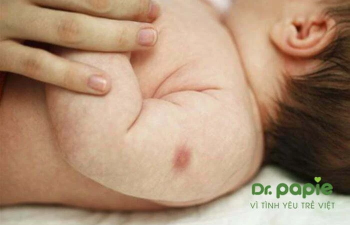 Có nên dán miếng dán hạ sốt vào chỗ tiêm? Nên dán miếng dán hạ sốt vào đâu an toàn nhất Vết tiêm trên tay trẻ