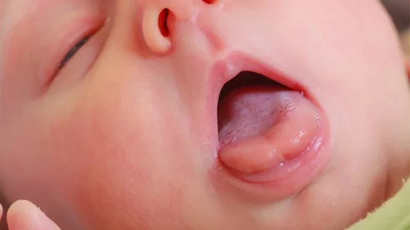 Rơ lưỡi cho bé thường xuyên giúp hạn chế tình trạng trắng lưỡi, tưa lưỡi Rơ lưỡi cho bé thường xuyên giúp hạn chế tình trạng trắng lưỡi, tưa lưỡi