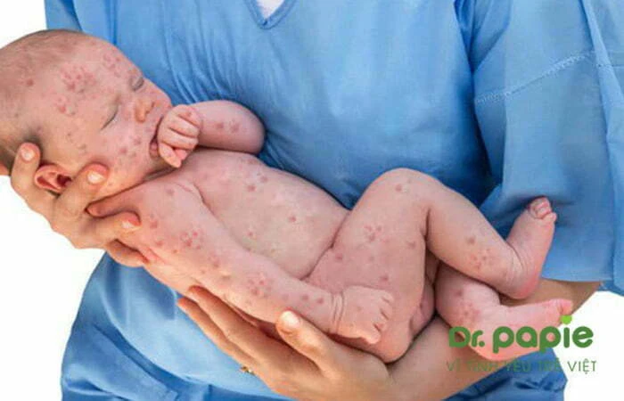Dấu hiệu, cách xử trí và cách phòng ngừa biến chứng sốt phát ban ở trẻ em biến chứng thần kinh ở trẻ sốt phát ban