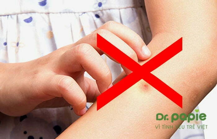 Dấu hiệu, cách xử trí và cách phòng ngừa biến chứng sốt phát ban ở trẻ em Không gãi các vết ban