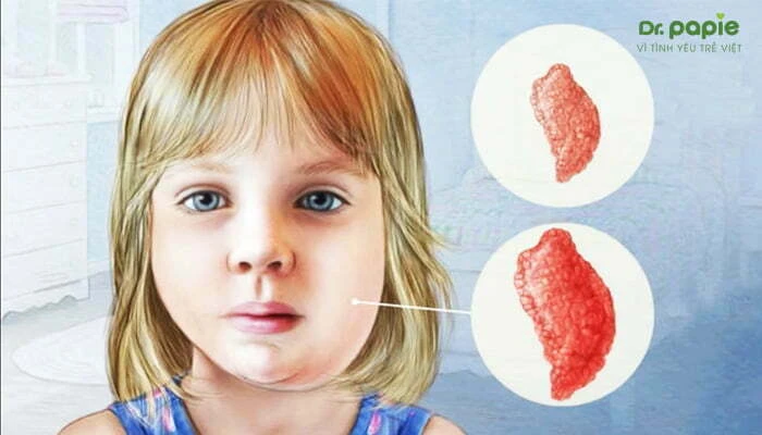 Dấu hiệu quai bị ở trẻ theo 4 giai đoạn dễ nhận biết Hình ảnh quai bị ở trẻ