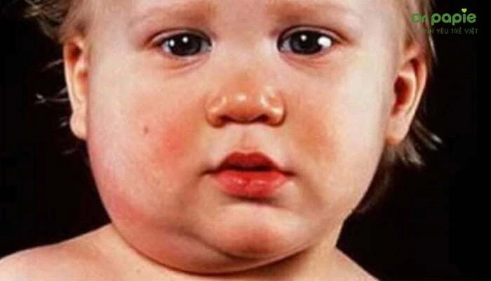 Dấu hiệu quai bị ở trẻ theo 4 giai đoạn dễ nhận biết Quai bị ở trẻ
