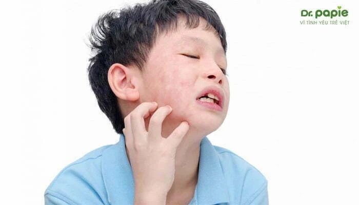 Dấu hiệu quai bị ở trẻ theo 4 giai đoạn dễ nhận biết Trẻ sưng đau tuyến nước bọt