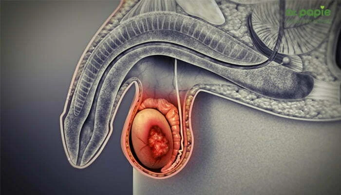 Dấu hiệu quai bị ở trẻ theo 4 giai đoạn dễ nhận biết Viêm tinh hoàn ở bé trai