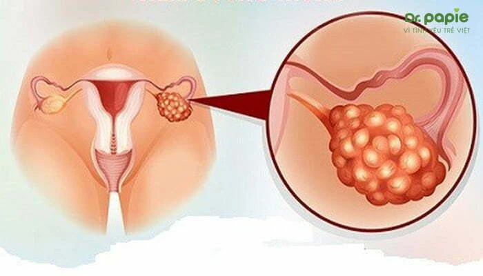 Dấu hiệu quai bị ở trẻ theo 4 giai đoạn dễ nhận biết Viêm buồng trứng do quai bị