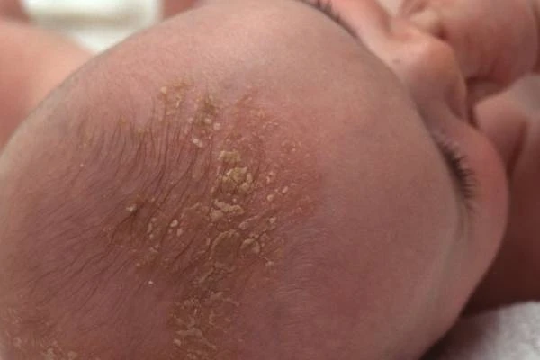 hết cứt trâu sau dùng dr.papie hết cứt trâu sau dùng dr.papie