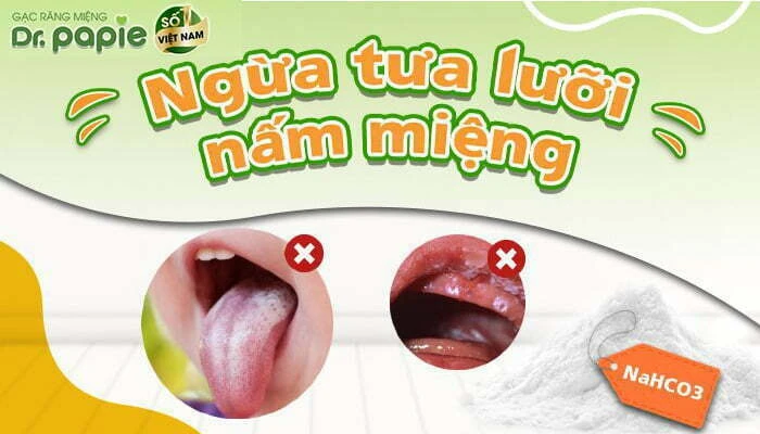 Gạc rơ lưỡi cho bé có NaHCO3 - Vì sao mẹ nên chọn NaHCO3 giúp ngăn ngừa - hõ trợ điều trị tưa lưỡi, nấm miệng