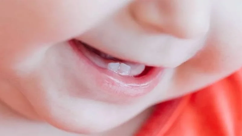 Di truyền là nguyên nhân chủ yếu khiến trẻ chậm mọc răng Di truyền là nguyên nhân chủ yếu khiến trẻ chậm mọc răng