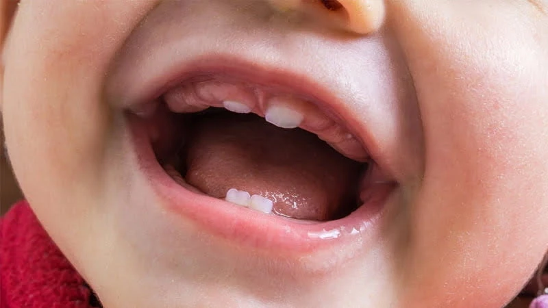 Trẻ sau 12 tháng chưa mọc răng được coi là chậm mọc răng Trẻ sau 12 tháng chưa mọc răng được coi là chậm mọc răng