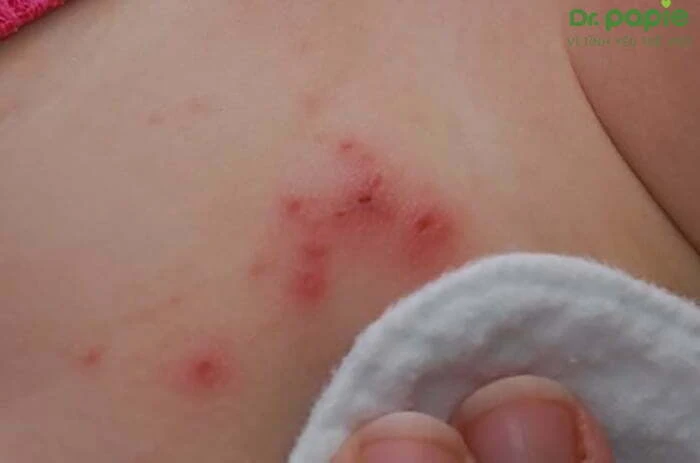 Hăm tã bao lâu thì khỏi và cách chữa hăm tã nhanh nhất Khi trẻ có dấu hiệu nhiễm khuẩn thì thời gian trị hăm tã của bé sẽ kéo dài thêm từ 5 - 7 ngày