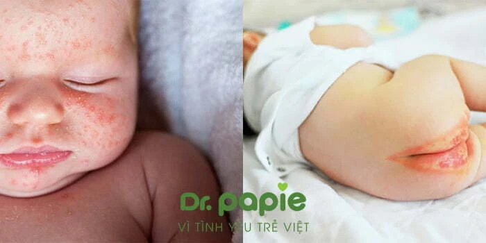Hăm Tã Và Rôm Sảy: Chi tiết 9+ cách phân biệt CHÍNH XÁC Hăm tã và rôm sảy