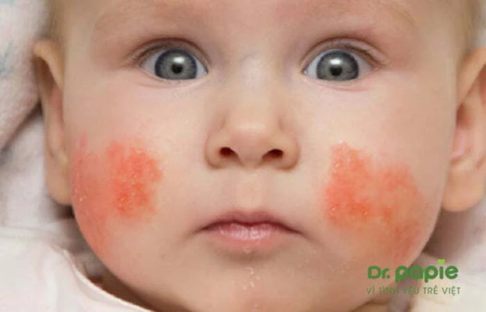 Chàm sữa cấp tính thể phong nhiệt