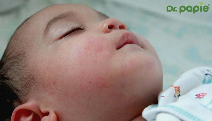 Hướng dẫn phân biệt sốt siêu vi và sốt xuất huyết Sốt xuất huyết