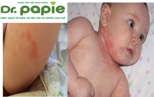 Hướng dẫn trị hăm tã cho bé an toàn cho bé từ A - Z huong dan tri ham ta cho be an toan cho be tu a z