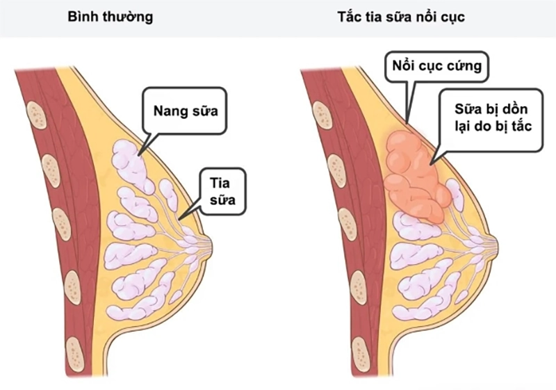 Mẹ bị tắc tia sữa phải làm sao? Cách xử lý nhanh nhất me bi tac tia sua phai lam sao cach xu ly nhanh nhat 1