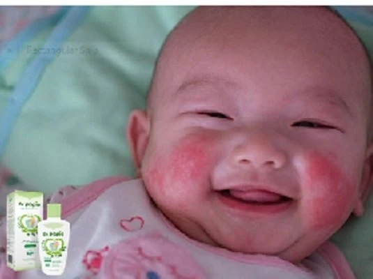 Mẹo chữa chàm sữa ở trẻ sơ sinh đơn giản dễ làm Các triệu chứng chàm sữa ở trẻ sơ sinh mẹ nên chú ý