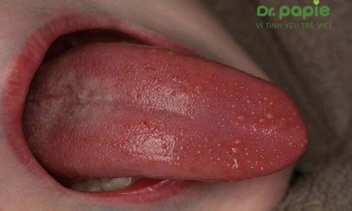Nấm miệng ở trẻ sơ sinh bao lâu thì khỏi và có tự hết không? nấm miệng ở trẻ em có chảy máu
