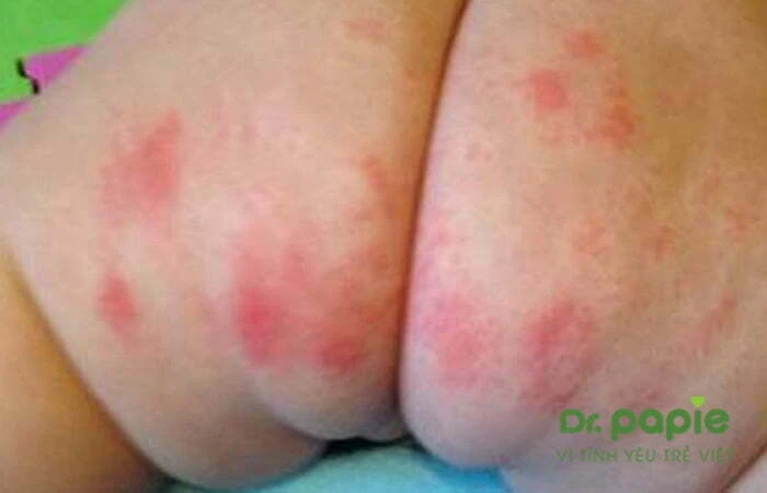 Nguyên nhân & cách phòng ngừa hăm tã trong suốt giai đoạn sơ sinh của trẻ  Các mụn nhỏ li ti xuất hiện do hăm tã ở mông