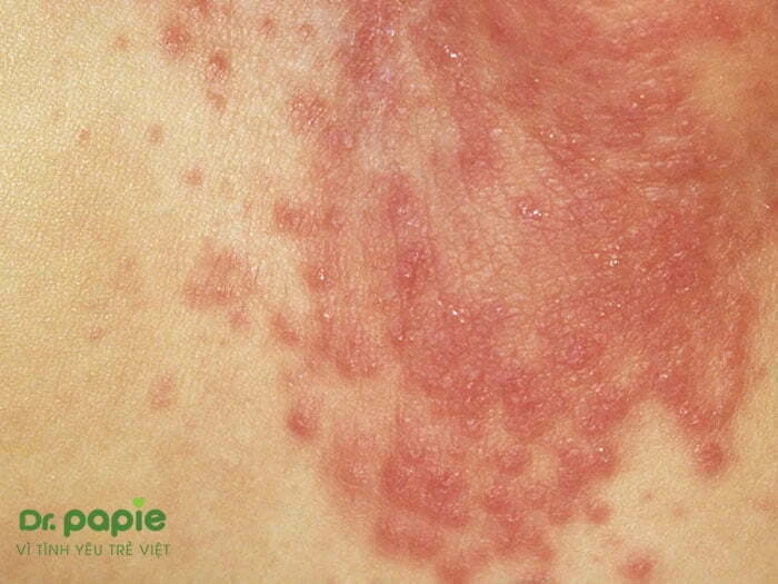 Hăm tã nổi mụn