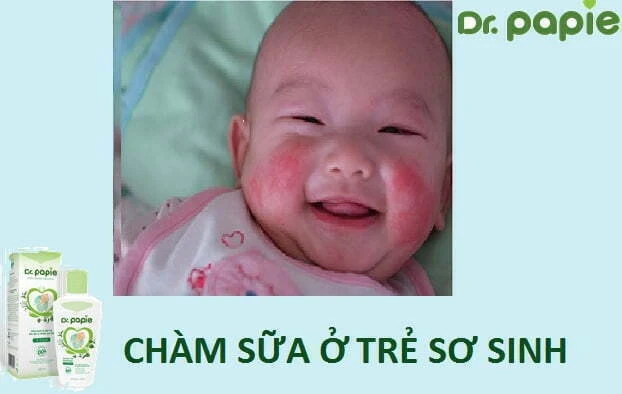 nguyen nhan trieu chung cach dieu tri cham sua o tre so sinh