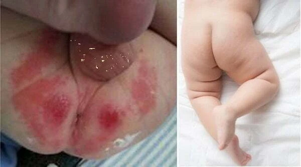 Vệ sinh bộ phận sinh dục bé trai và bé gái Vệ sinh bộ phận sinh dục cho bé trai