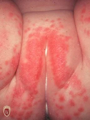 Vệ sinh bộ phận sinh dục bé trai và bé gái Nổi mụn, nút đỏ gây ngứa, khó chịu cho "cô bé nhỏ"