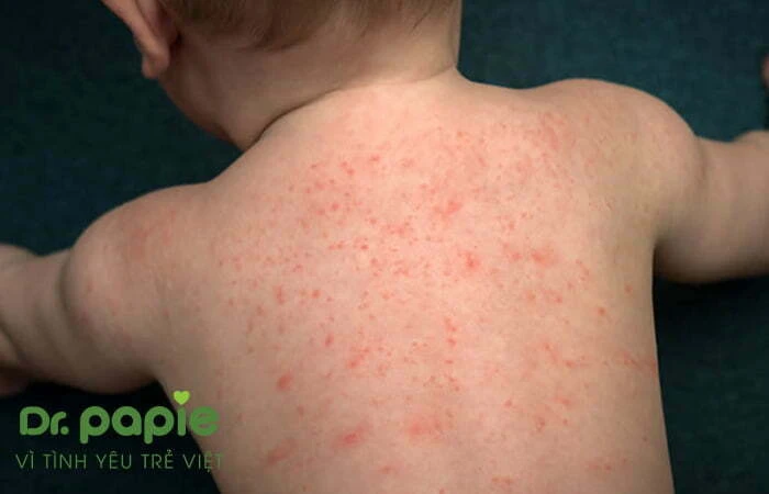 Phân biệt sốt phát ban và sởi ở trẻ nhỏ & cách điều trị tại nhà Sốt phát ban toàn thân ở trẻ
