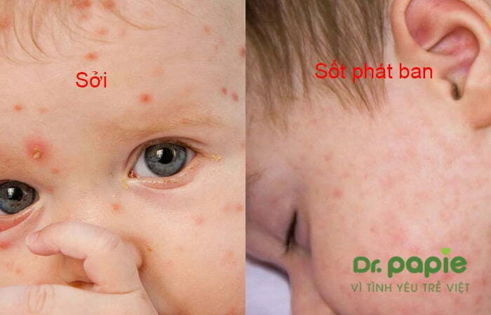 Phân biệt sốt phát ban và sởi ở trẻ nhỏ & cách điều trị tại nhà Phân biệt sởi và sốt phát ban thông thường