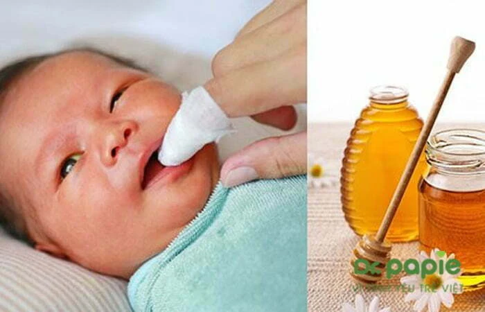 Có nên rơ lưỡi cho trẻ sơ sinh bằng mật ong Có nên rơ lưỡi cho trẻ sơ sinh bằng mật ong