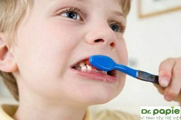 Sâu răng trẻ em – bố mẹ tuyệt đối không được xem nhẹ sau rang tre em bo me tuyet doi khong duoc xem nhe 2