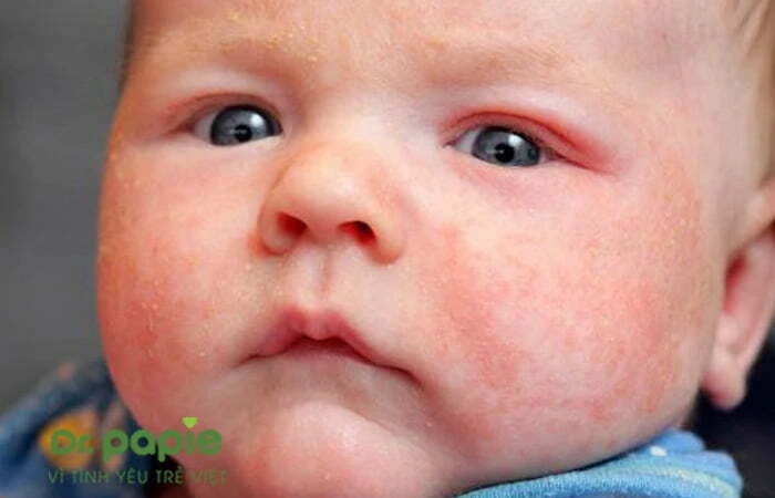 Chàm sữa khô có nguy hiểm không? Nguyên nhân và cách chăm sóc bé bị chàm sữa khô