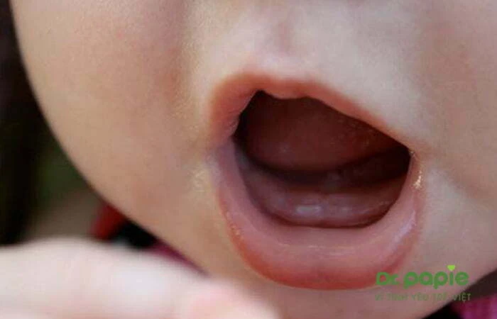 Hình ảnh nướu trẻ có răng đâm lên