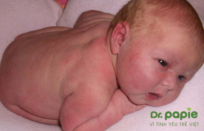 Hình ảnh trẻ nổi ban khi sốt