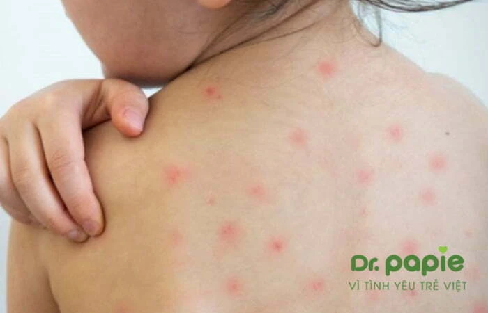 Sốt phát ban dạng sởi ở trẻ em: Dấu hiệu nhận biết, cách điều trị và phòng ngừa Trẻ sốt phát ban dạng sởi toàn thân