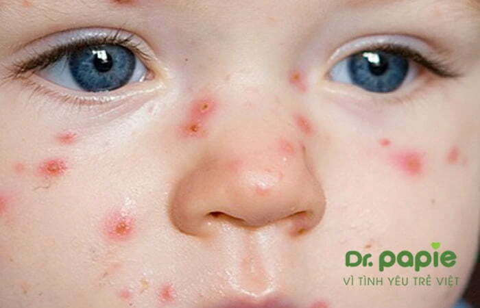 Sốt phát ban dạng sởi ở trẻ em: Dấu hiệu nhận biết, cách điều trị và phòng ngừa Sốt phát ban dạng sởi