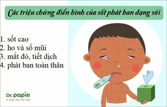 Sốt phát ban dạng sởi ở trẻ em: Dấu hiệu nhận biết, cách điều trị và phòng ngừa Triệu chứng của sốt phát ban dạng sởi